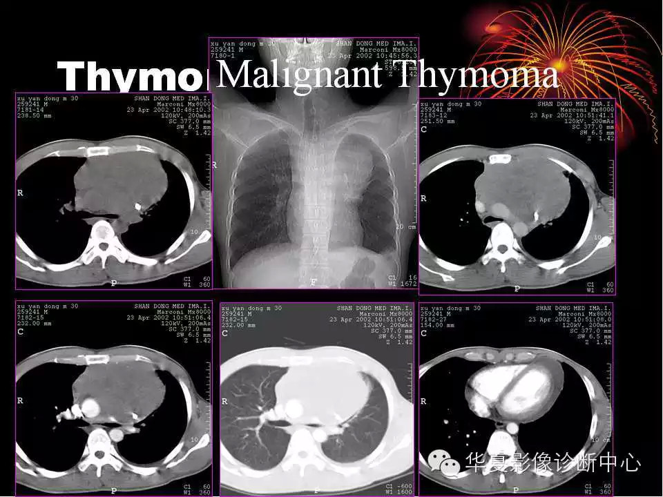 肺与纵隔的影像诊断