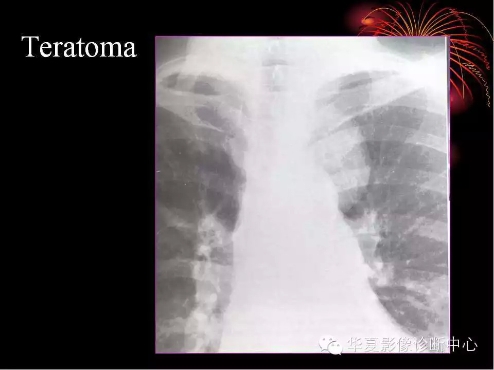 肺与纵隔的影像诊断