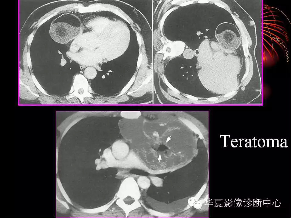 肺与纵隔的影像诊断