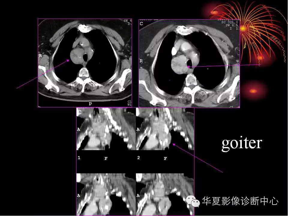 肺与纵隔的影像诊断