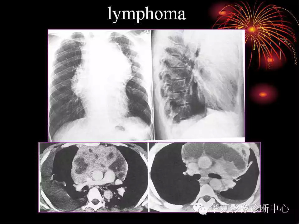 肺与纵隔的影像诊断