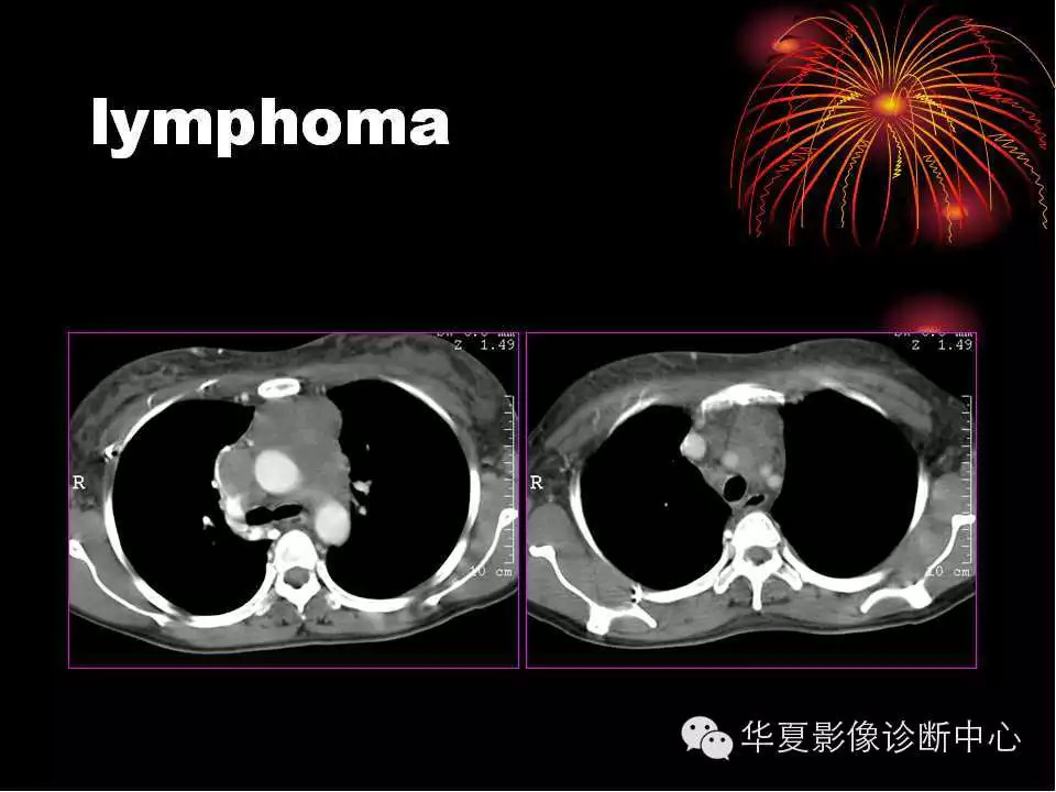 肺与纵隔的影像诊断