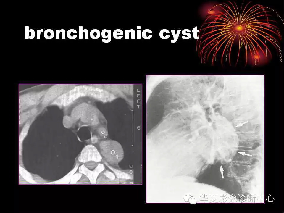 肺与纵隔的影像诊断