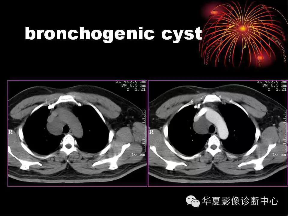 肺与纵隔的影像诊断