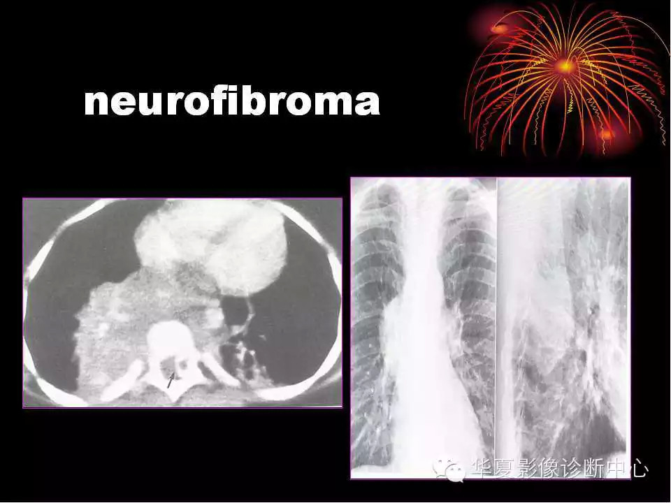 肺与纵隔的影像诊断