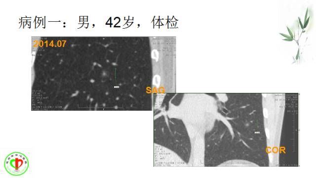 肺部微小结节再认识