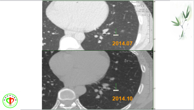 肺部微小结节再认识