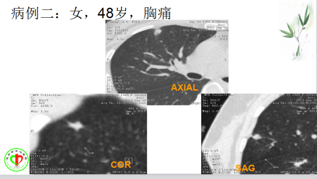 肺部微小结节再认识