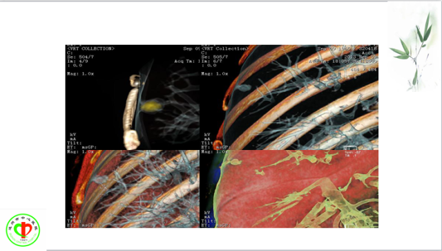肺部微小结节再认识