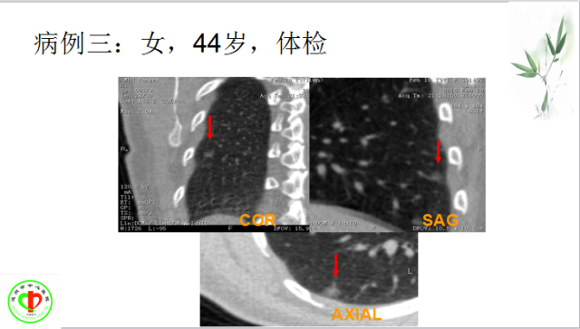 肺部微小结节再认识