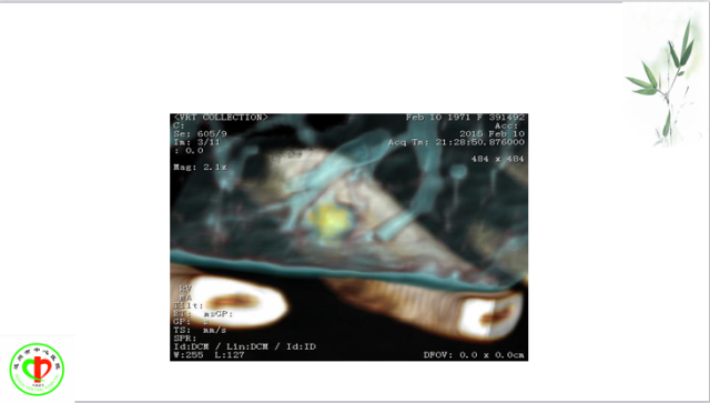 肺部微小结节再认识