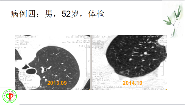 肺部微小结节再认识