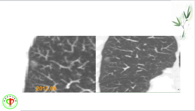 肺部微小结节再认识