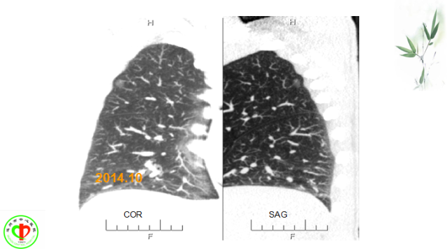 肺部微小结节再认识