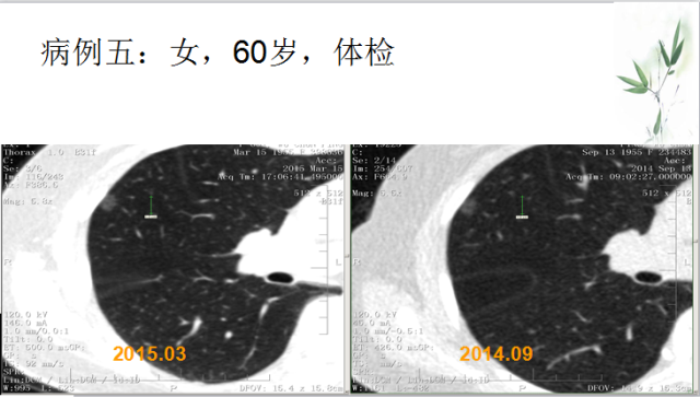 肺部微小结节再认识