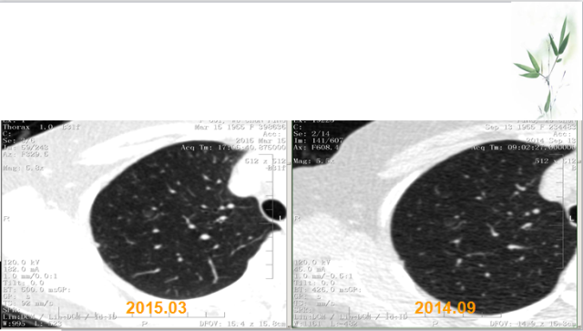 肺部微小结节再认识