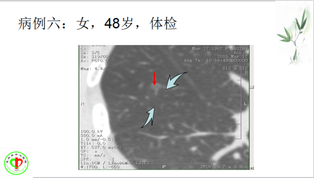 肺部微小结节再认识