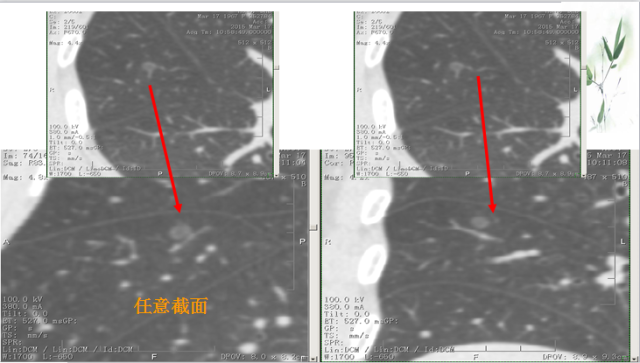 肺部微小结节再认识