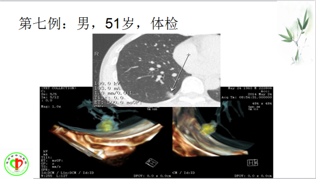 肺部微小结节再认识