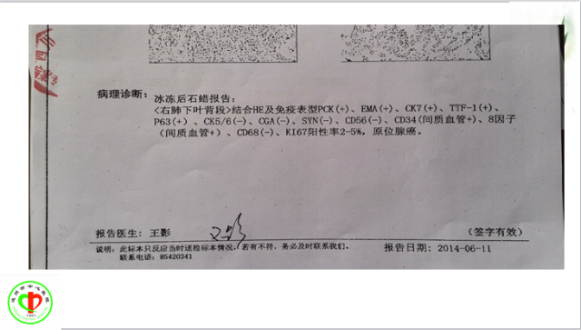 肺部微小结节再认识