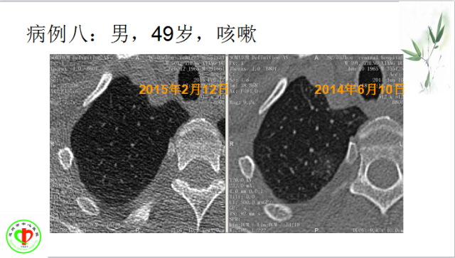 肺部微小结节再认识