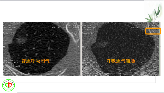 肺部微小结节再认识