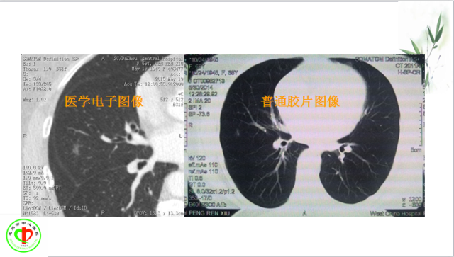 肺部微小结节再认识