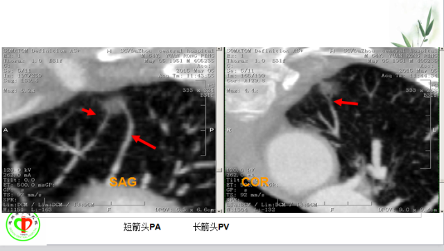 肺部微小结节再认识