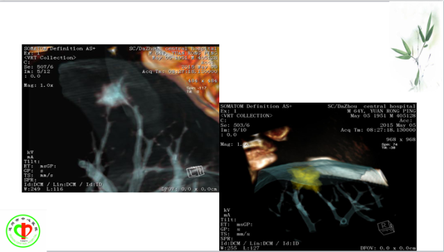 肺部微小结节再认识