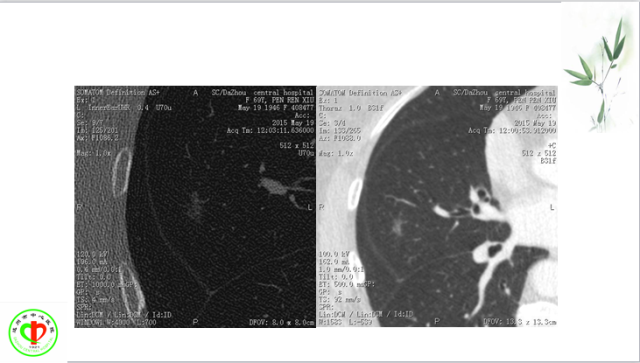 肺部微小结节再认识