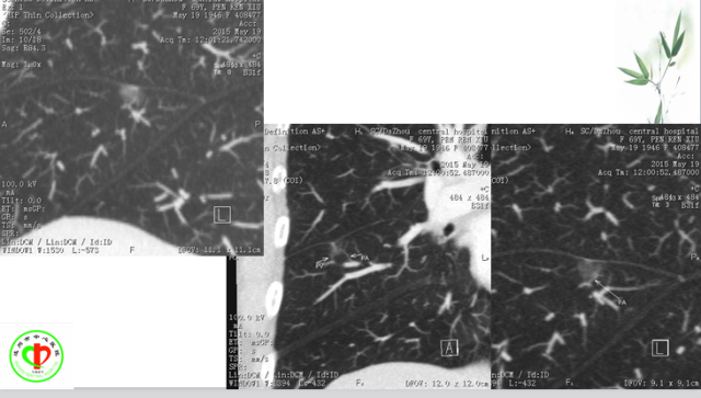肺部微小结节再认识