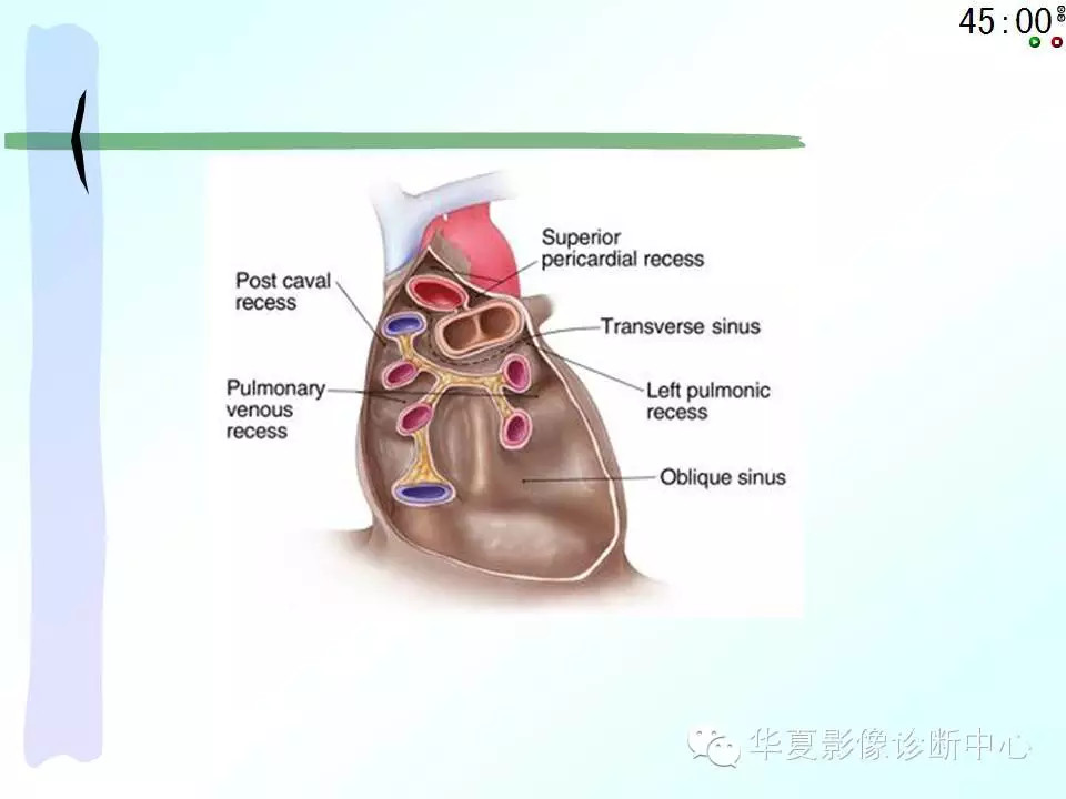 心包隐窝、心包窦的解剖