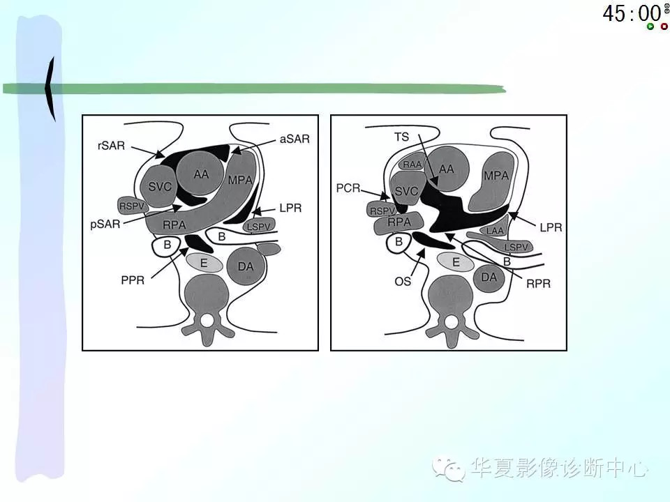 心包隐窝、心包窦的解剖