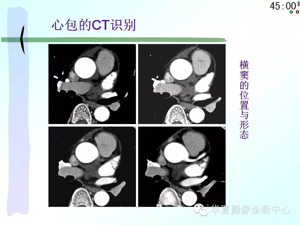 心包隐窝、心包窦的解剖