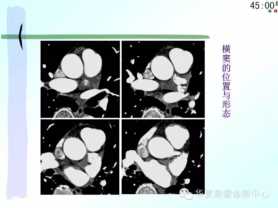 心包隐窝、心包窦的解剖