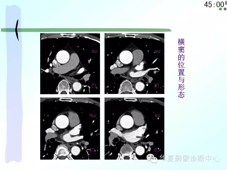 心包隐窝、心包窦的解剖