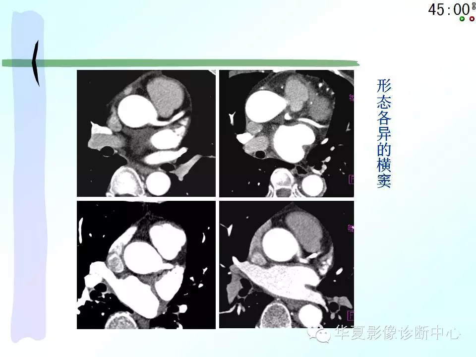 心包隐窝、心包窦的解剖