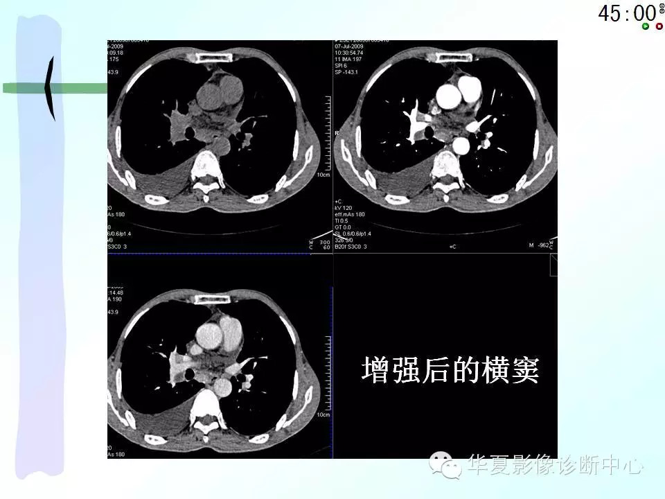 心包隐窝、心包窦的解剖