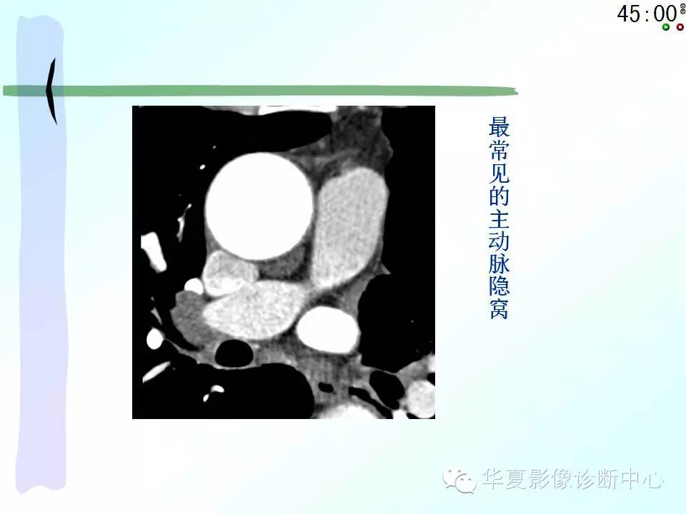 心包隐窝、心包窦的解剖