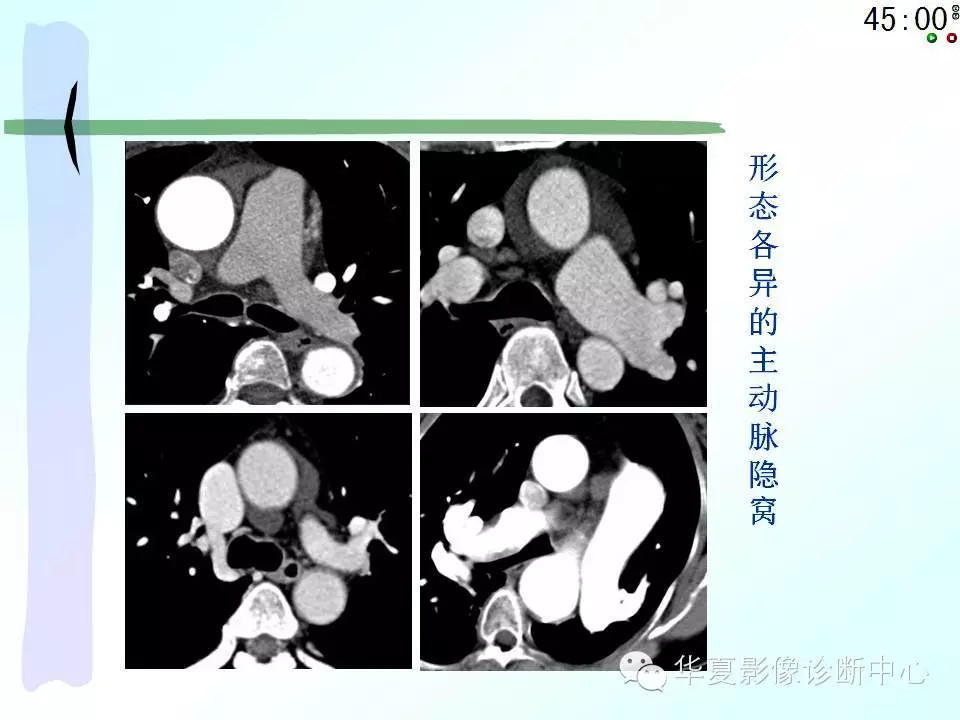 心包隐窝、心包窦的解剖