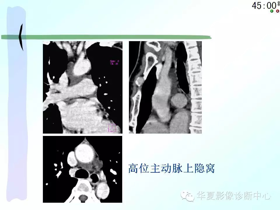 心包隐窝、心包窦的解剖