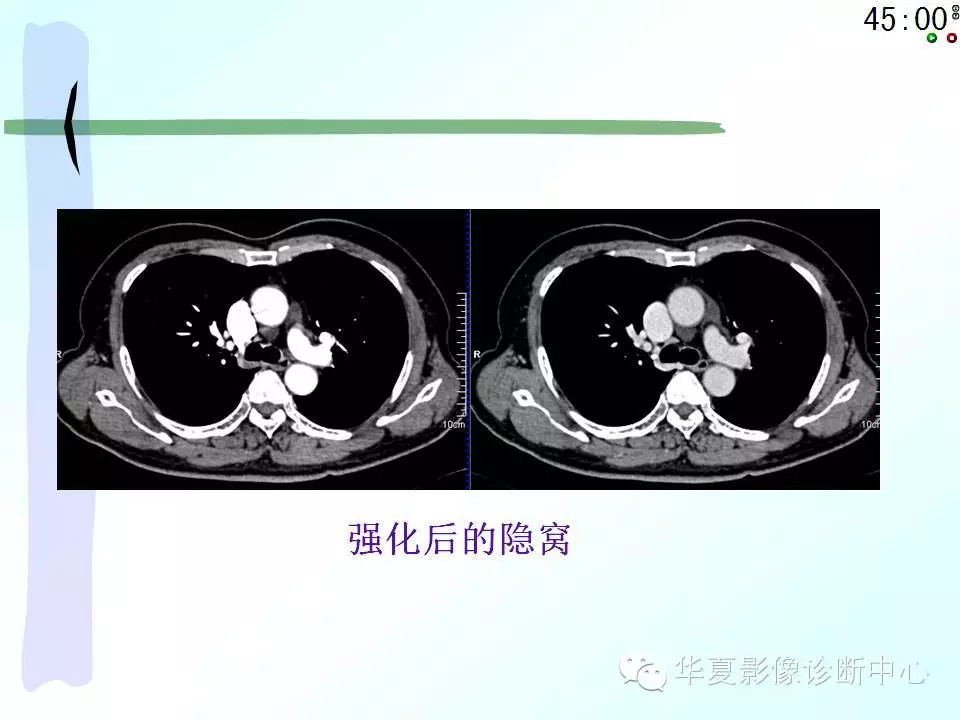 心包隐窝、心包窦的解剖