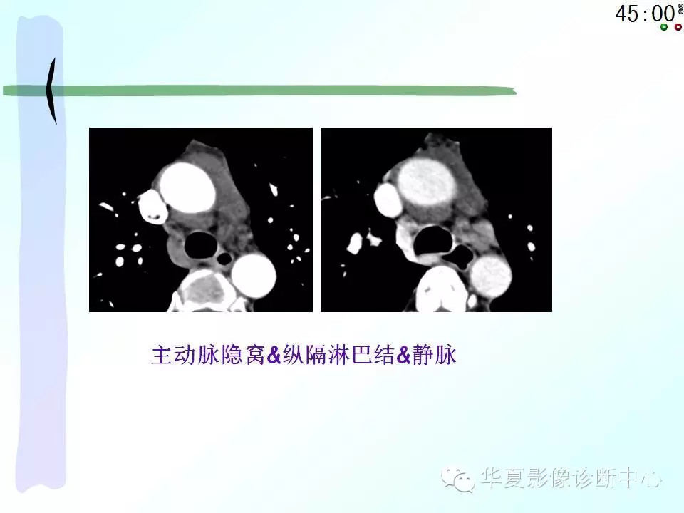 心包隐窝、心包窦的解剖