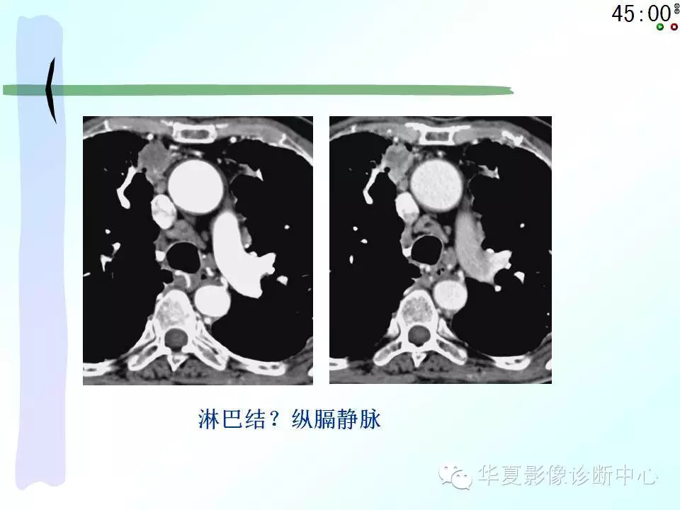 心包隐窝、心包窦的解剖