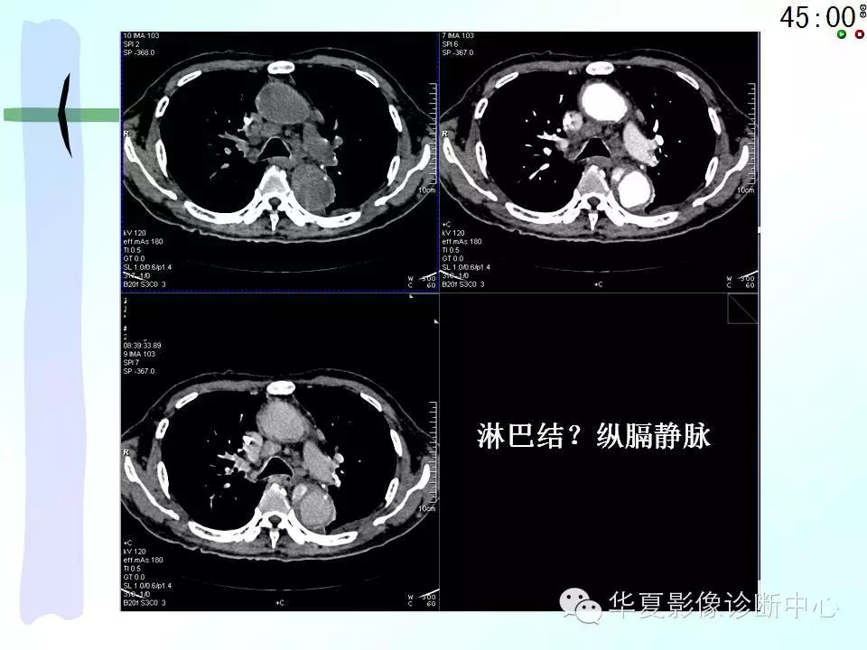 心包隐窝、心包窦的解剖