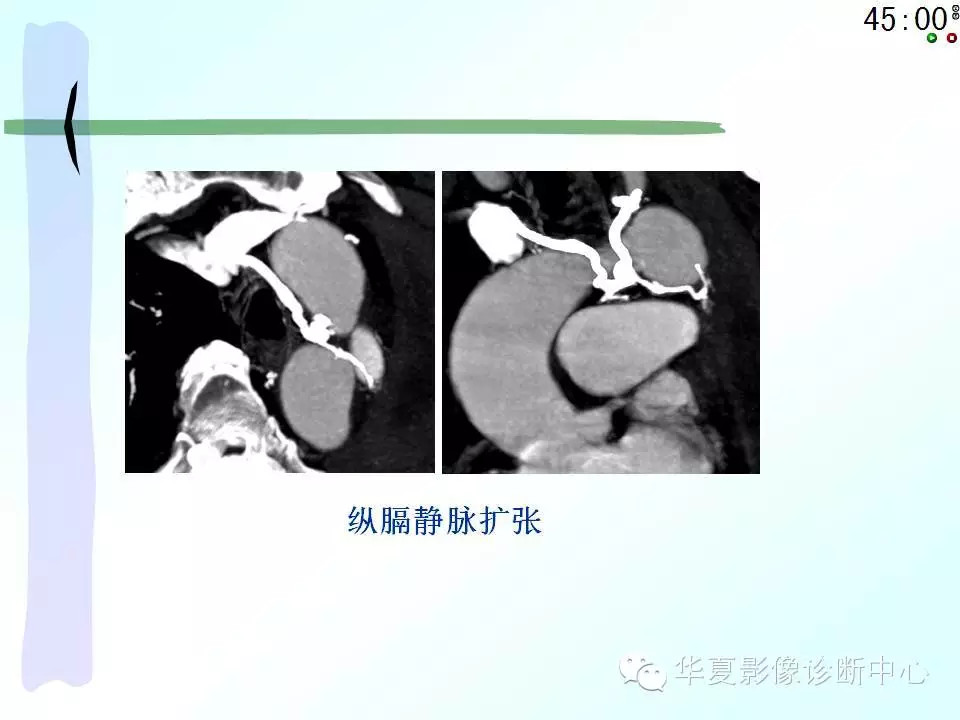 心包隐窝、心包窦的解剖