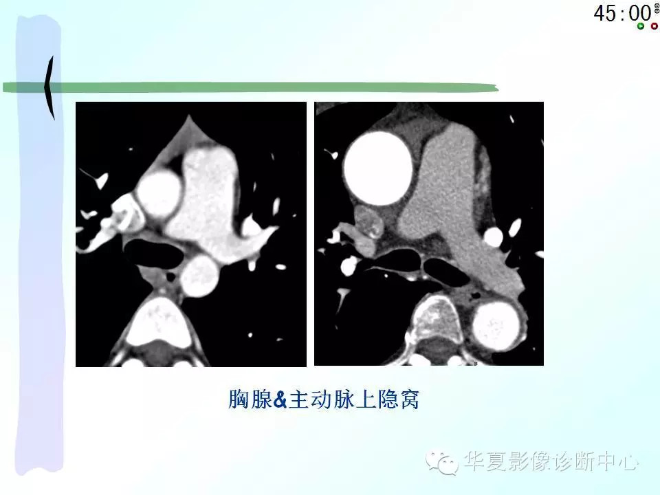 心包隐窝、心包窦的解剖