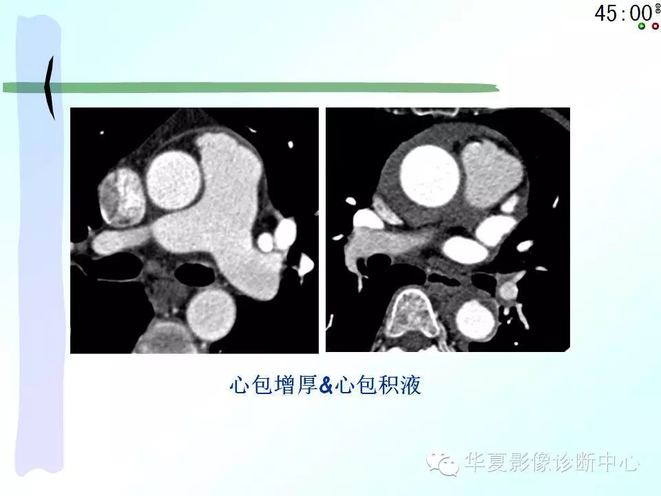 心包隐窝、心包窦的解剖