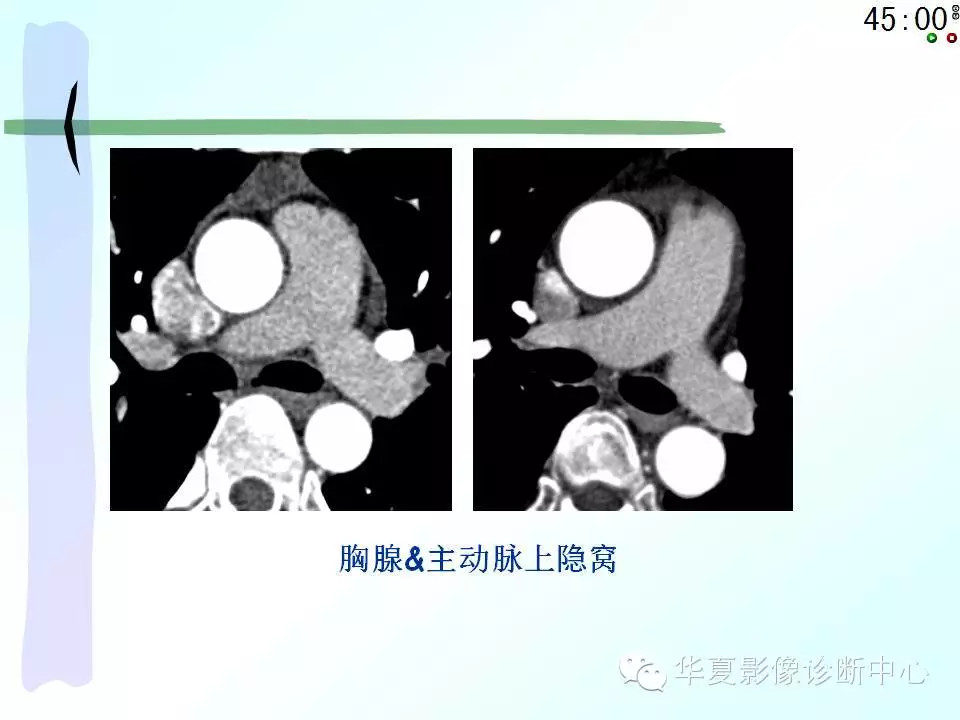 心包隐窝、心包窦的解剖