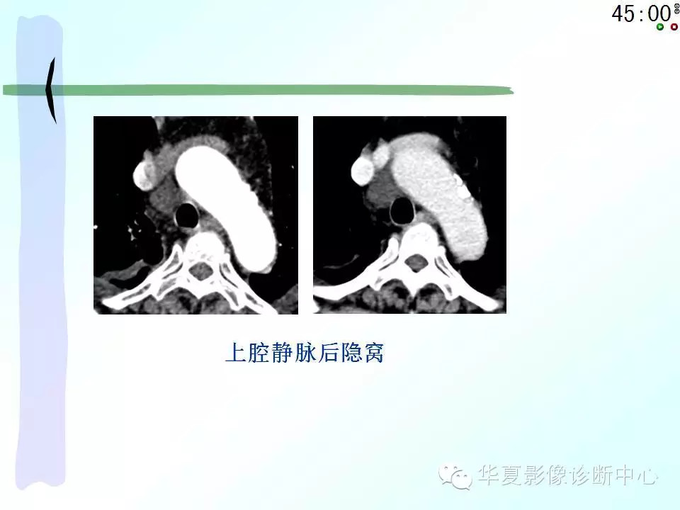心包隐窝、心包窦的解剖